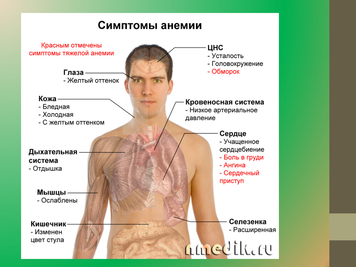 Нехватка железа симптомы. Низкое давление при анемии. Малокровие с низким давлением.