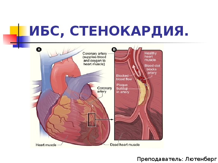 Ишемия передней стенки. Ишемическая кардиомиопатия. ИБС И стенокардия это одно и тоже или нет.