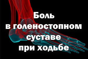 Боль в голеностопном суставе. Болит голеностопный сустав при ходьбе без травмы. Внезапная боль в голеностопном суставе при ходьбе. Боли в голеностопном суставе в покое и при ходьбе без травмы. Болит голеностопный сустав при ходьбе лечение как лечить.