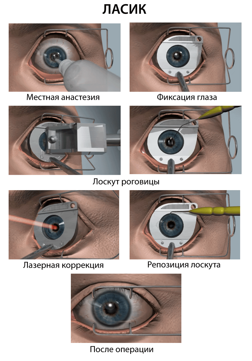 Коррекция зрения сравнение. Коррекция зрения методом ласик. Лазерная коррекция зрения LASIK. Лазерная операция на глаза ласик. Лазерная коррекция зрения Femto LASIK.