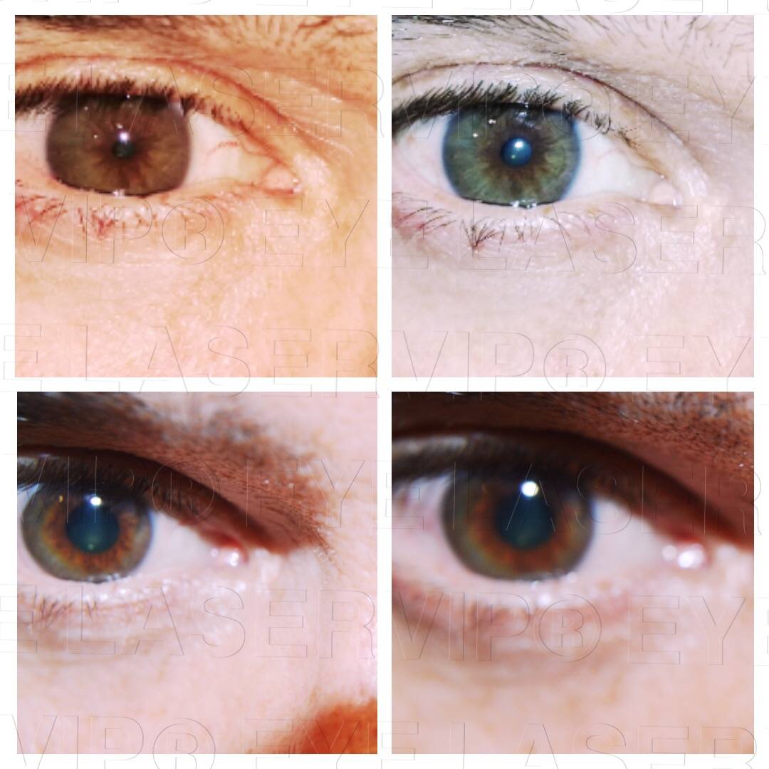Отбелить глаза в домашних условиях. Изменение цвета глаз. Осветление цвета глаз лазером. Изменение цвета Радужки глаз. Изменение пигмента глаз.