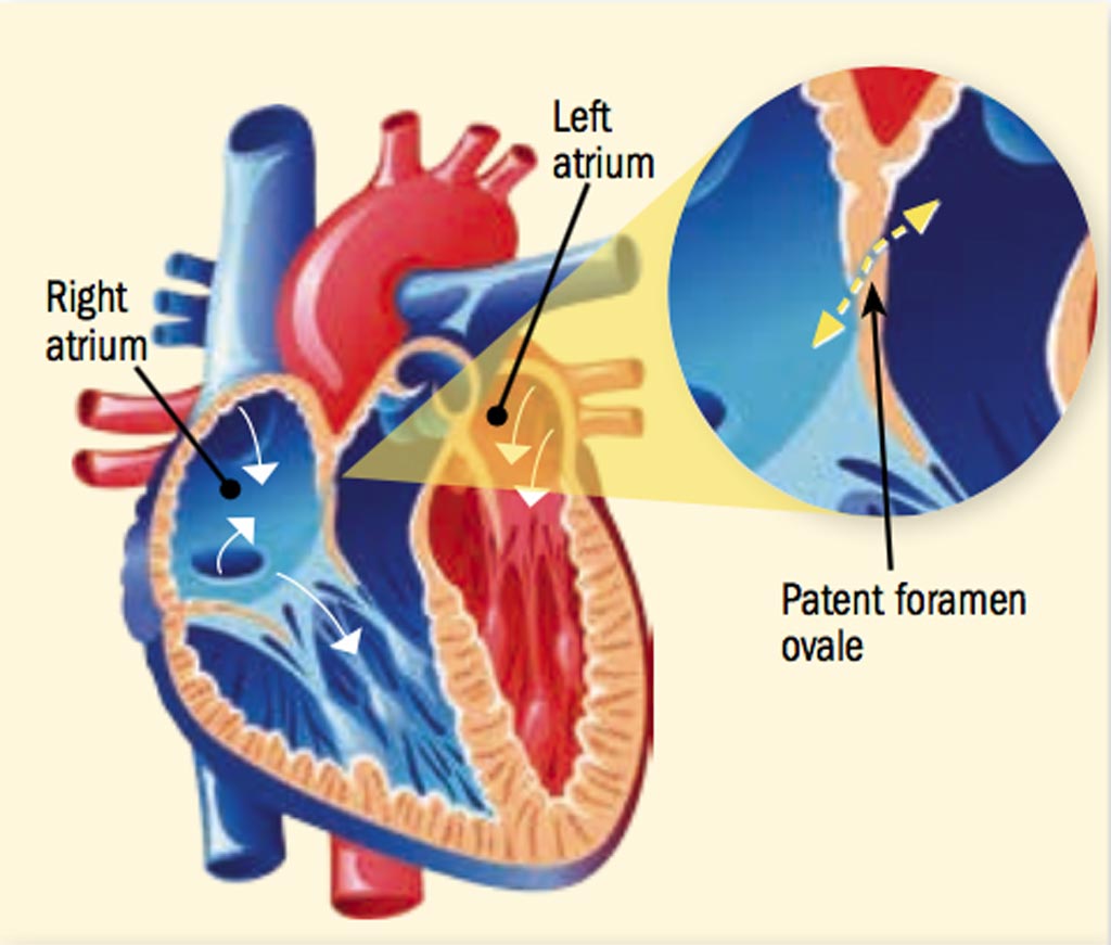 1 3 окно в сердце. Foramen ovale сердце. Открытое овальное окно в сердце. Анатомия сердца овальное окно.