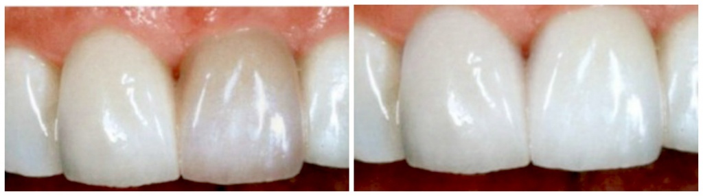Отбеливание девитальных зубов с измененным цветом как собрать ингалятор литл доктор