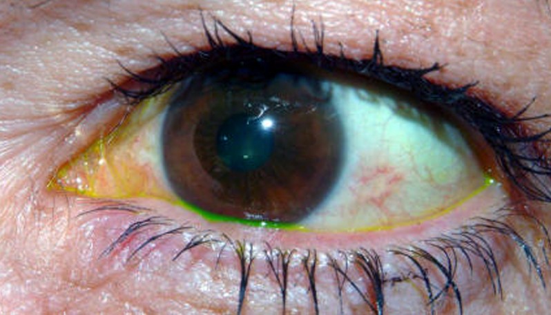 Почему глаза желтоватого. Конъюнктивит пингвекула. Пингвекула пингвекула птеригиум. Меланоз конъюнктивы склеры глаза.