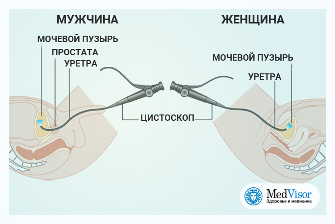 Цистоскопия мочевого у женщин. Цистоскопия мочевого пузыря у женщин. Подготовка к цистоскопии мочевого пузыря у мужчин. Цистоскопия мочевого пузыря у женщин протокол. Цистоскопия мочевого пузыря у женщин обезболивание.