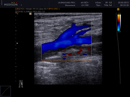 Узи вен нижних конечностей картинки