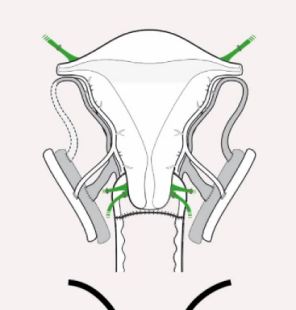 The uterus is fixed in the pelvis of the recipient