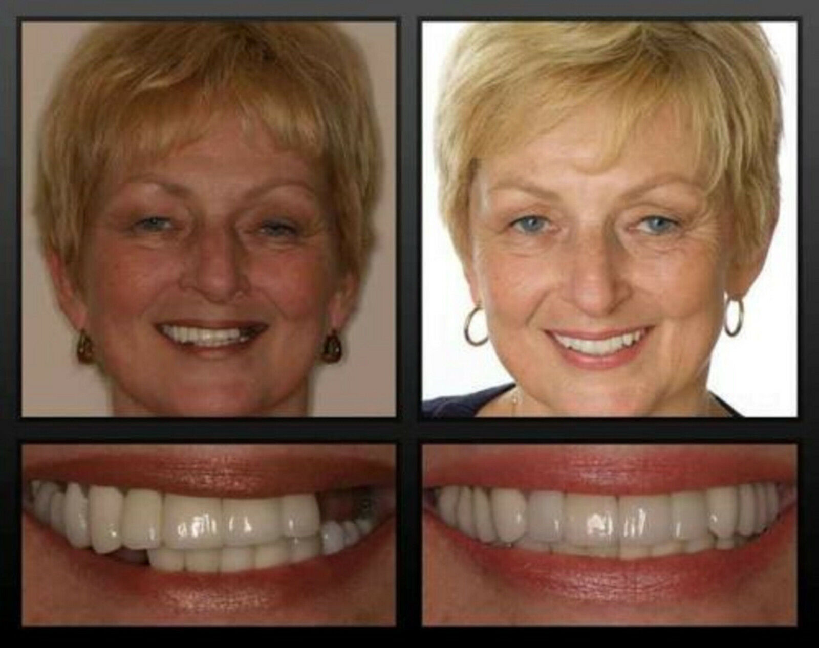 зубной мост на 3 зуба