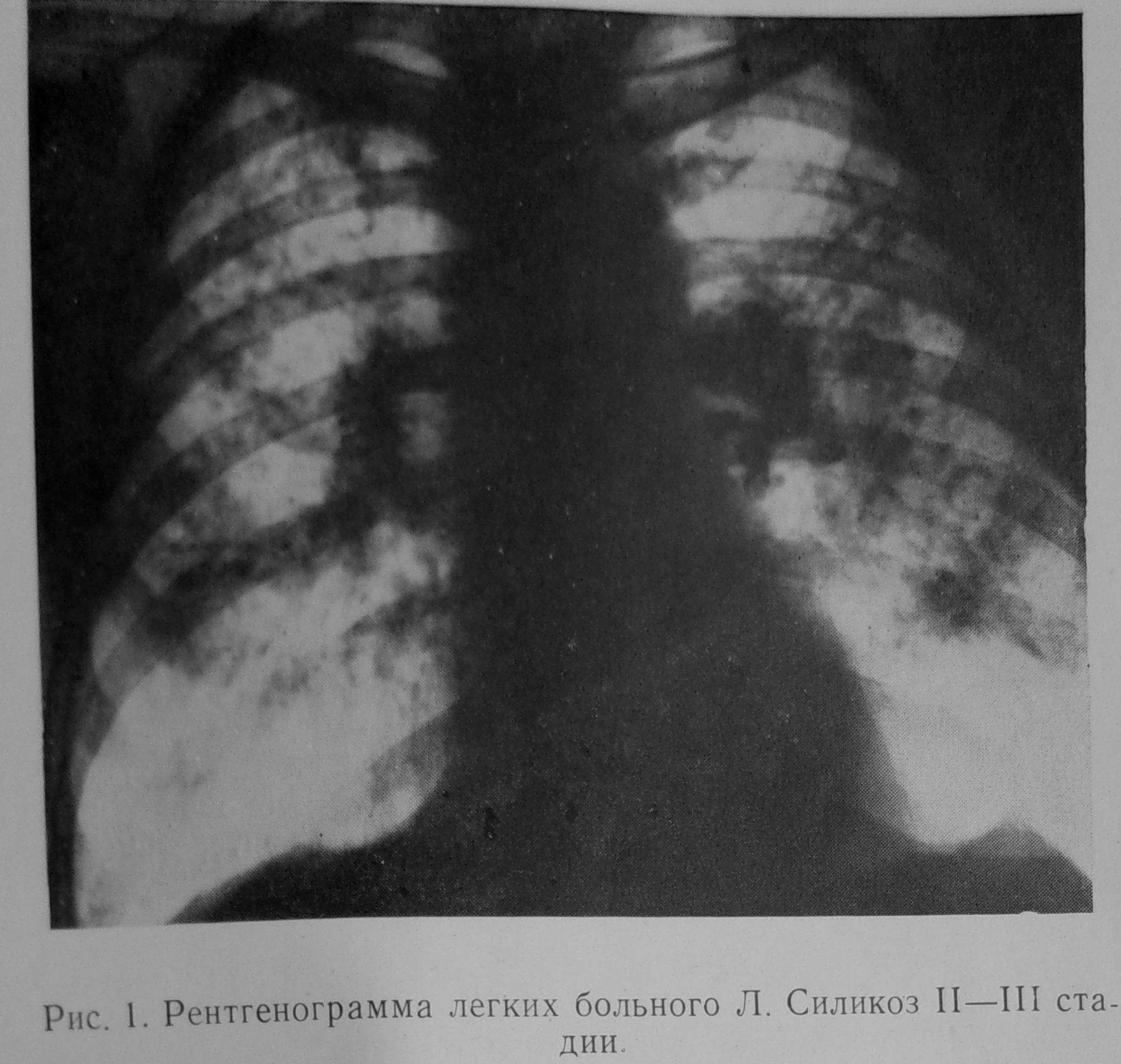 Силикоз. Силикоз рентген. Силикоз легких рентген. Силикоз 1 стадия рентген. Пневмокониозы силикотуберкулез.
