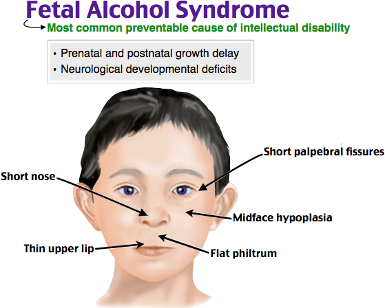 Фатальный алкоголический синдром. Фетальное лицо рисунок. Фетальный алкогольный синдром Гретта.
