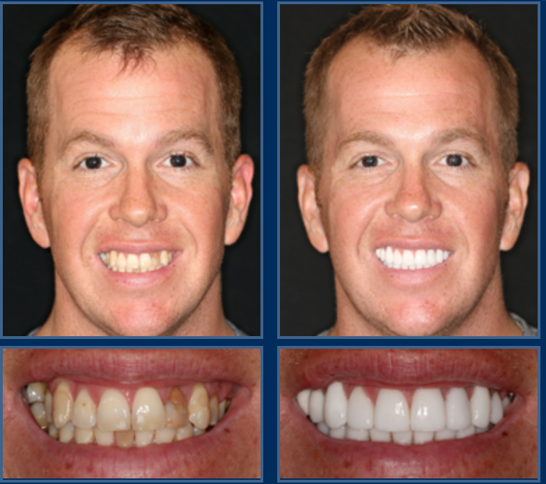 Зубные протезы до и после. Импланты на передние зубы до и после. Несъемное протезирование передних зубов.