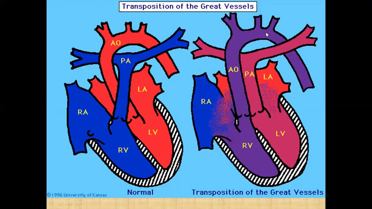 Транспозиция артерий. Полная транспозиция магистральных сосудов у детей. ТМС порок сердца гемодинамика. Транспозиция магистральных артерий у новорожденных. Полная транспозиция магистральных сосудов у детей гемодинамика.