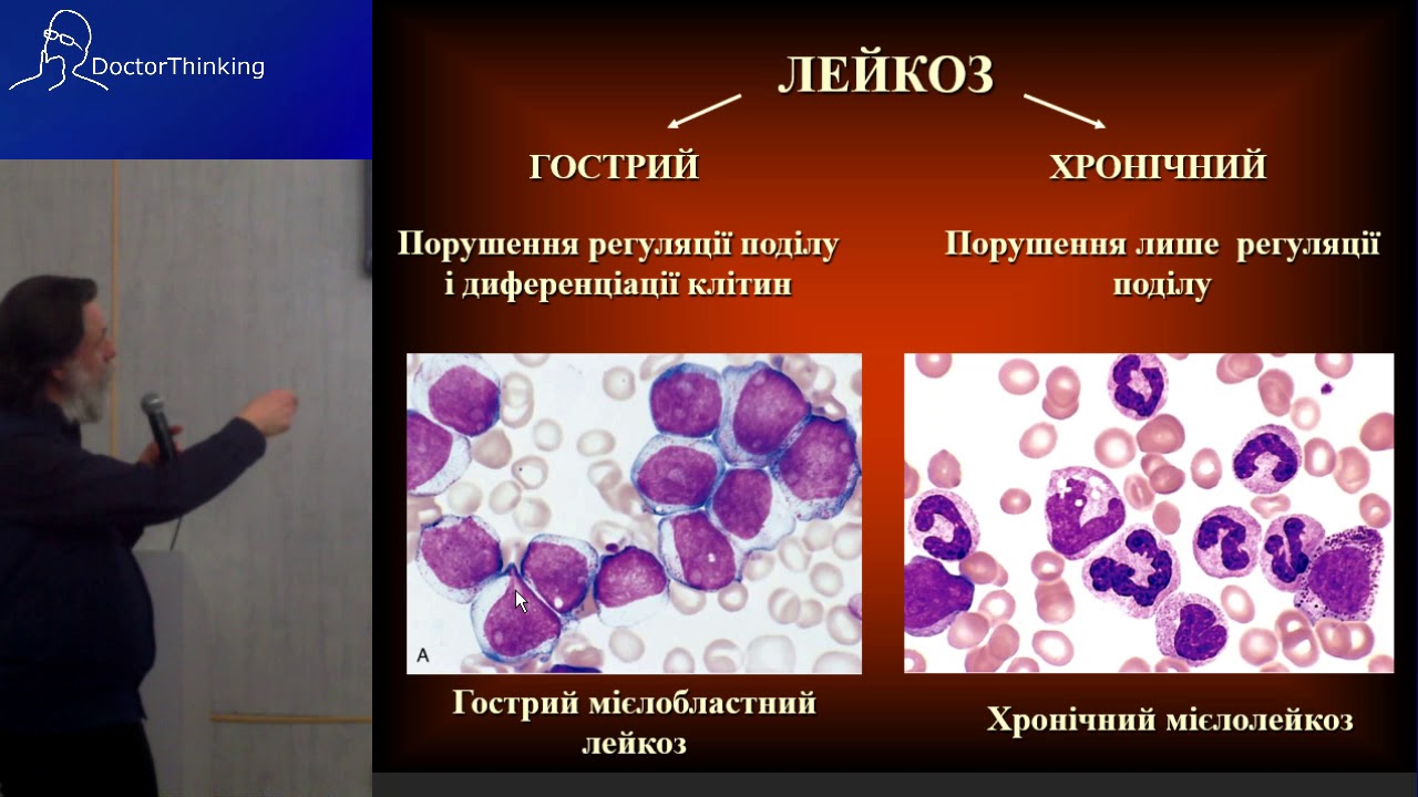 Лейкоз прошел. Острый и хронический лейкоз. Лстоый и хронисеский Лейко. Острый лейкоз и хронический лейкоз. Острый и хронический лейкоз отличия.