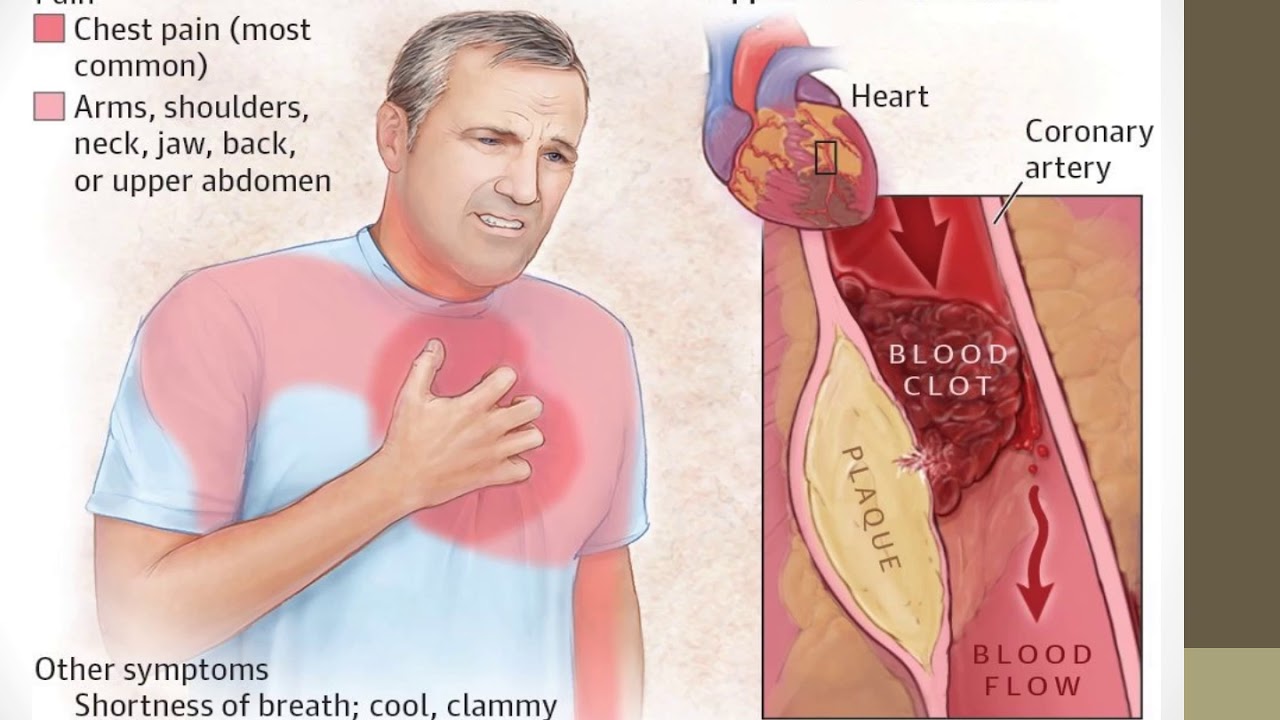 Причины боли сердца у мужчин. Острая коронарная недостаточность симптомы. Синдром острой коронарной недостаточности симптомы. Приступ стенокардии.