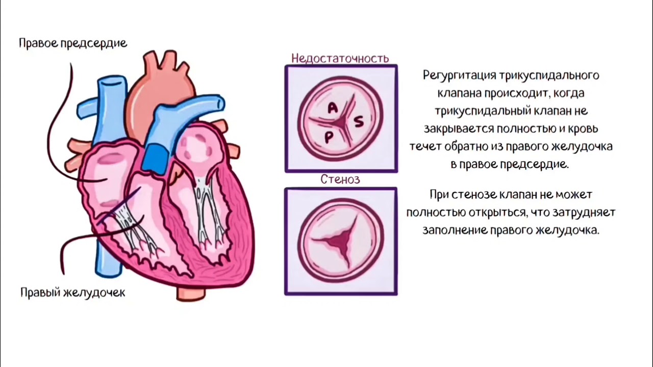 Недостаточность трехстворчатого клапана рисунок