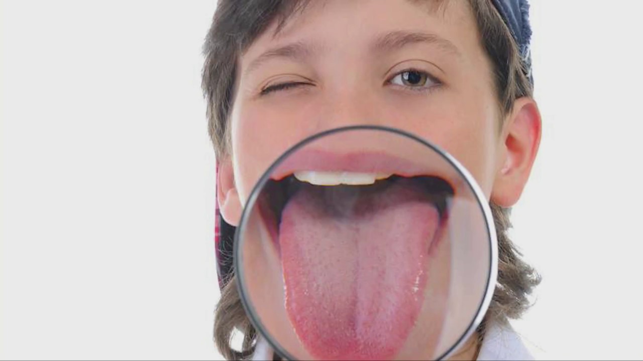 Язык высунутый изо рта. Гипопластический глоссит. Эксфолиативный глоссит.