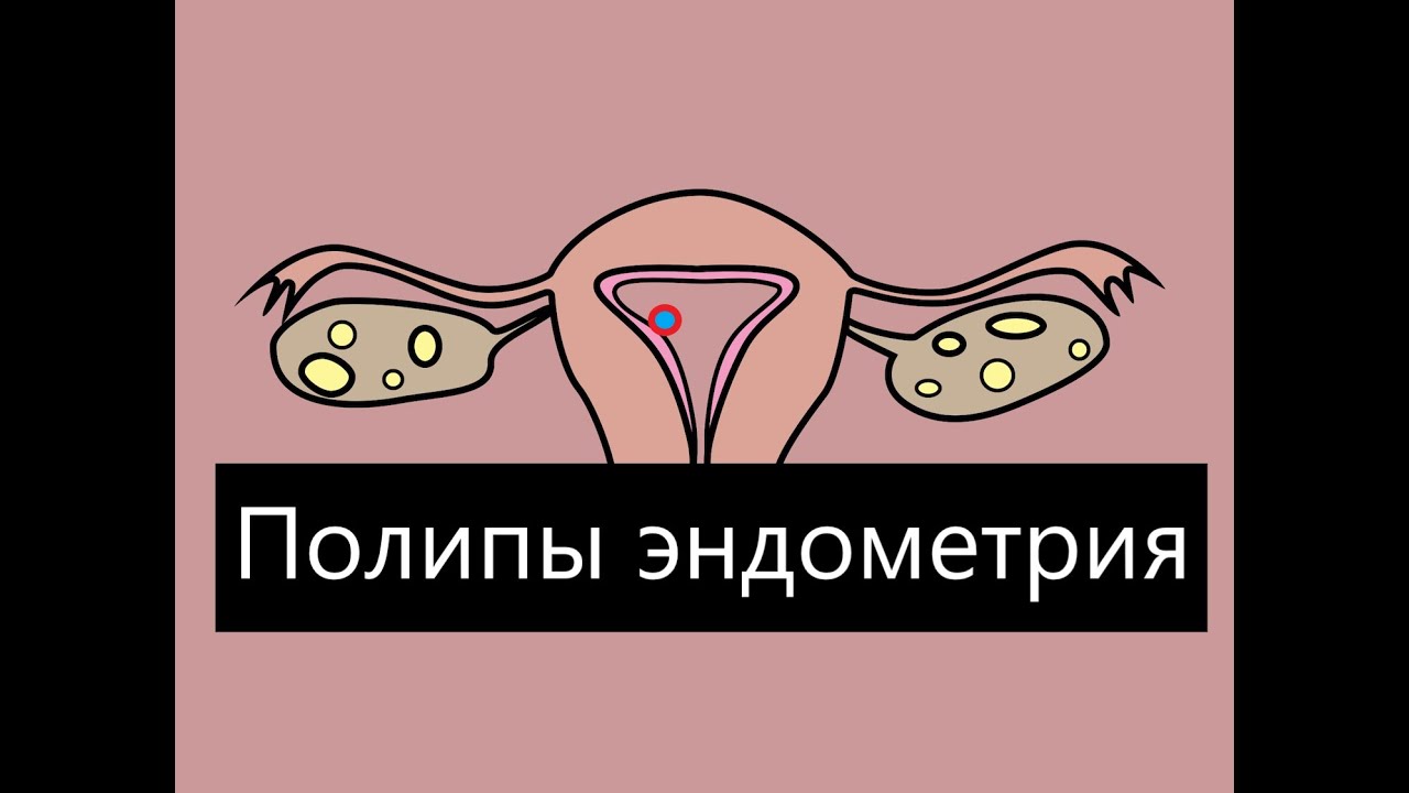 Эндометрий с включениями. Полипоз эндометрия на УЗИ. Полип и гиперплазия эндометрия на УЗИ. Ретрогрессивный вариант полипа эндометрия. Атипичная гиперплазия на УЗИ.