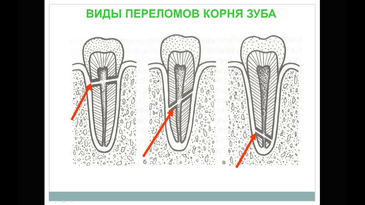 Клиновидный дефект стоматологическая карта лечение