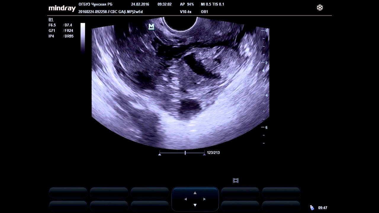 На узи видно внематочную. Внематочная беременность на УЗИ. УЗИ внематочной беременности 5 недель. УЗИ внематочной беременности на раннем сроке.