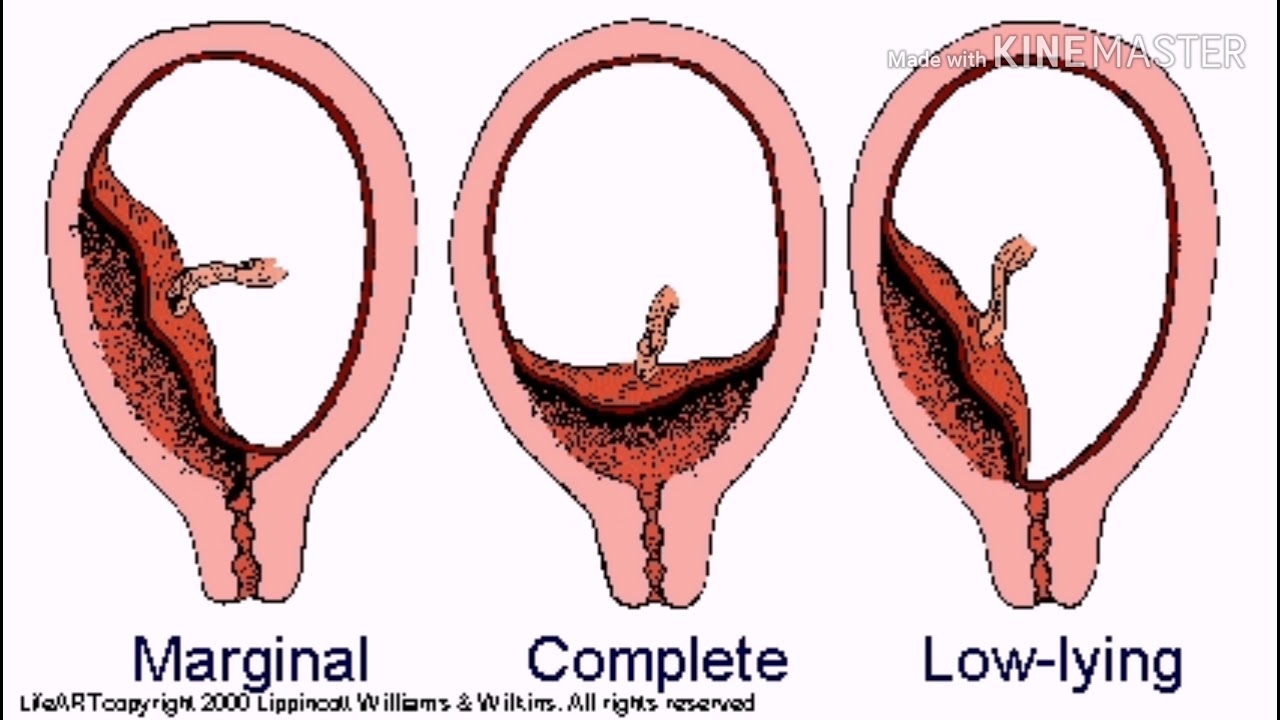 Краевое предлежание плаценты при беременности. Предлежание плаценты Березовская.