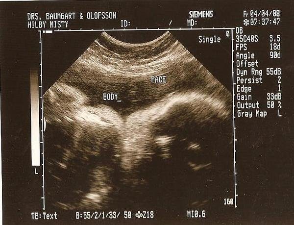 37 недель мальчик. Вес двойни на 37-38 неделе. Рождение мальчика на 37 неделе беременности. Печень плода на 37 неделе беременности. 37 Недель пограничный ребенок.