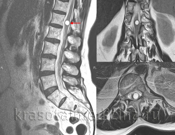 Киста позвоночного канала. Гидромиелия поясничного отдела позвоночника мрт. Сирингомиелия киста. Гидромиелия спинного мозга. Сирингомиелия грудного отдела позвоночника.