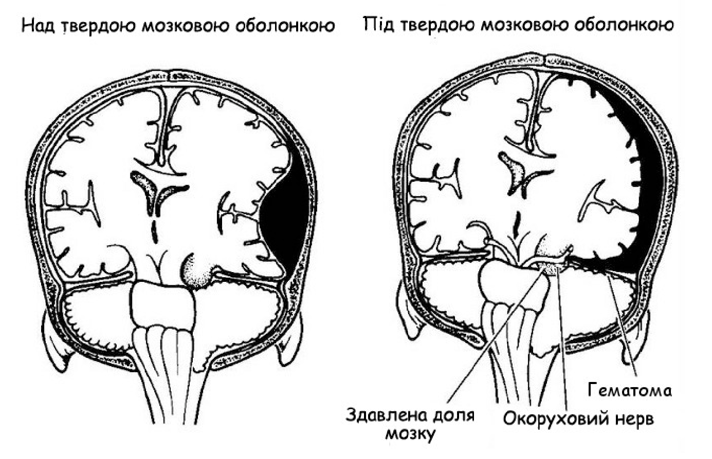 Сдавление мозга признаки. Мозговая черепная гематома. Сдавление головного мозга. Давление головного мозга. Сдавления вещества мозга.