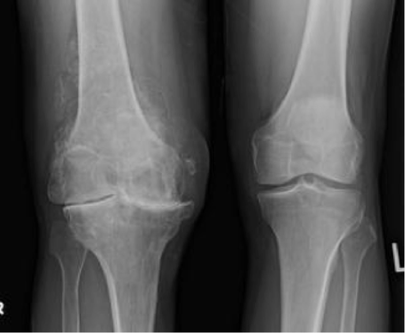 Артроз коленного сустава название. Гонартроз 4 степени коленного сустава рентген. Доа коленного сустава на рентгене. Деформирующий остеоартроз рентген. Деформирующий артроз (остеоартроз).