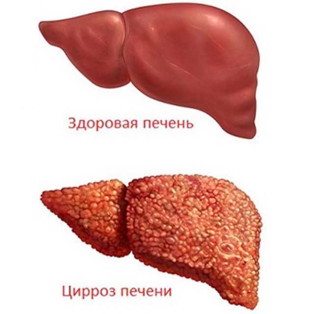 Изменения печени. Цирроз печени изменение в печень. Поликистоз печени цирроз печени. Рубцевание печени (цирроз). Кардиальный цирроз печени.