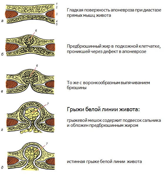 Грыжа прямой мышцы. Грыжа белой линии живота по УЗИ протокол. Грыжа белой линии живота на УЗИ. Грыжа белой линии живота на УЗИ заключение. Грыжа передней брюшной стенки на УЗИ протокол.