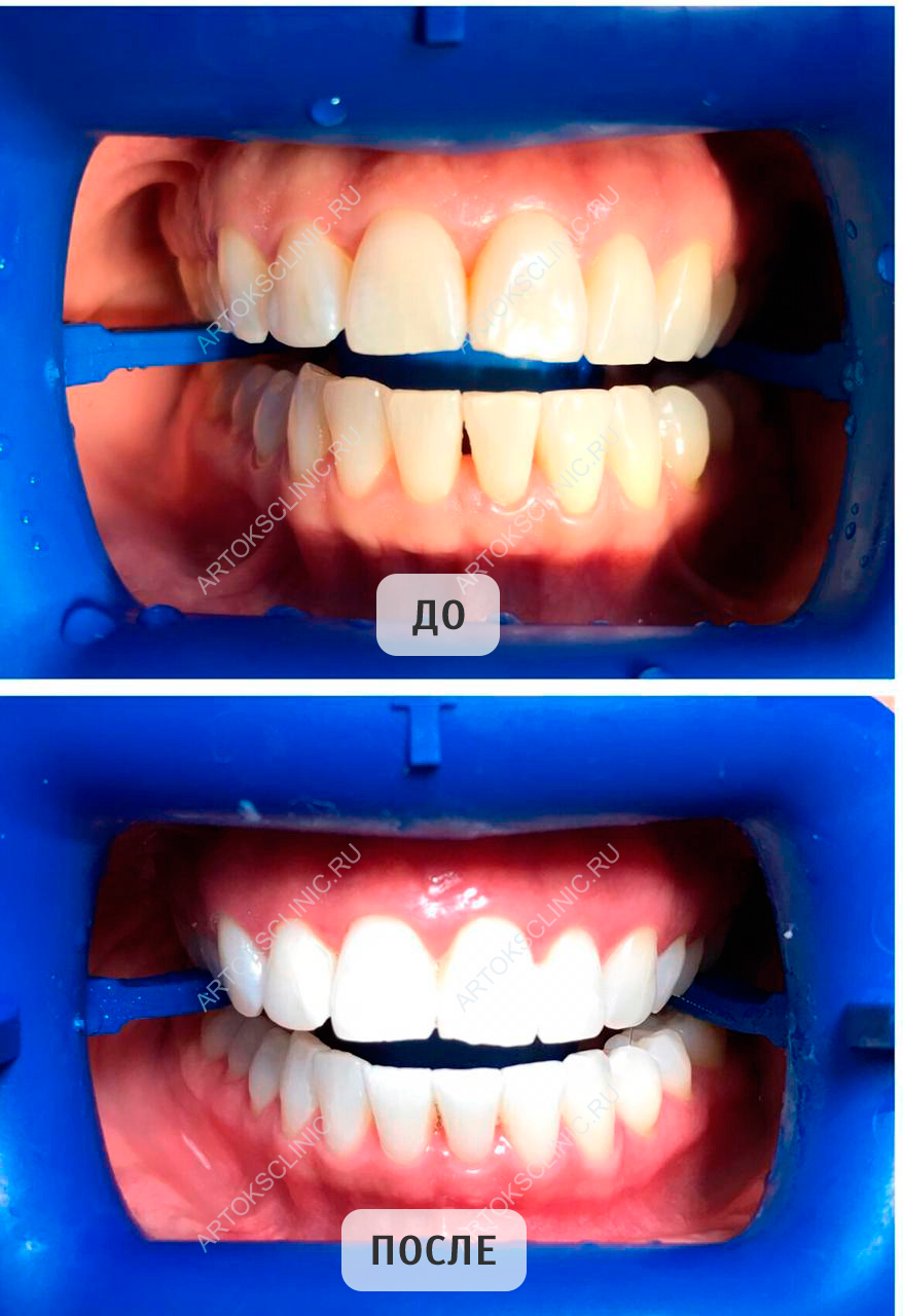 Отбеливание зубов цена нижний. Отбеливание зубов зоом 4. Отбеливание зубов до и после.