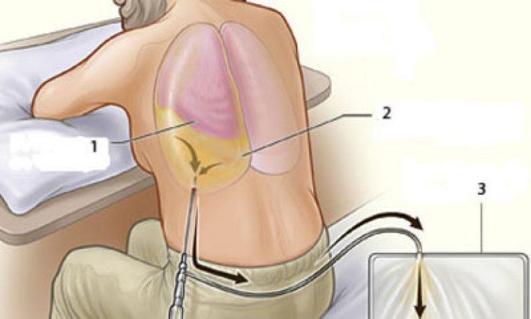 Жидкость после. Плевральная пункция гидроторакс. Плевральная пункция при пле. Пункция при гидро тораксе. Торакоцентез гидроторакс.