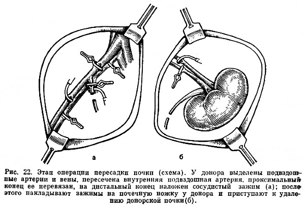 Операция По Пересадке Почки Стоимость