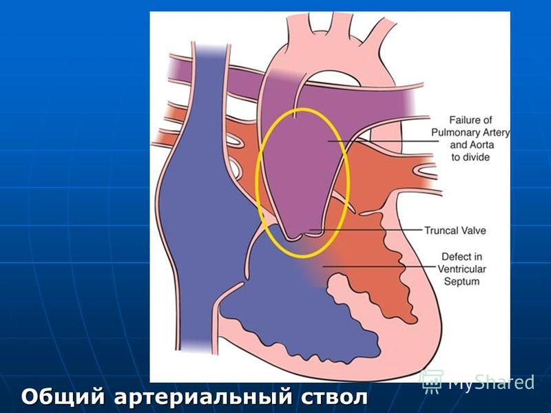 Общий артериальный ствол презентация