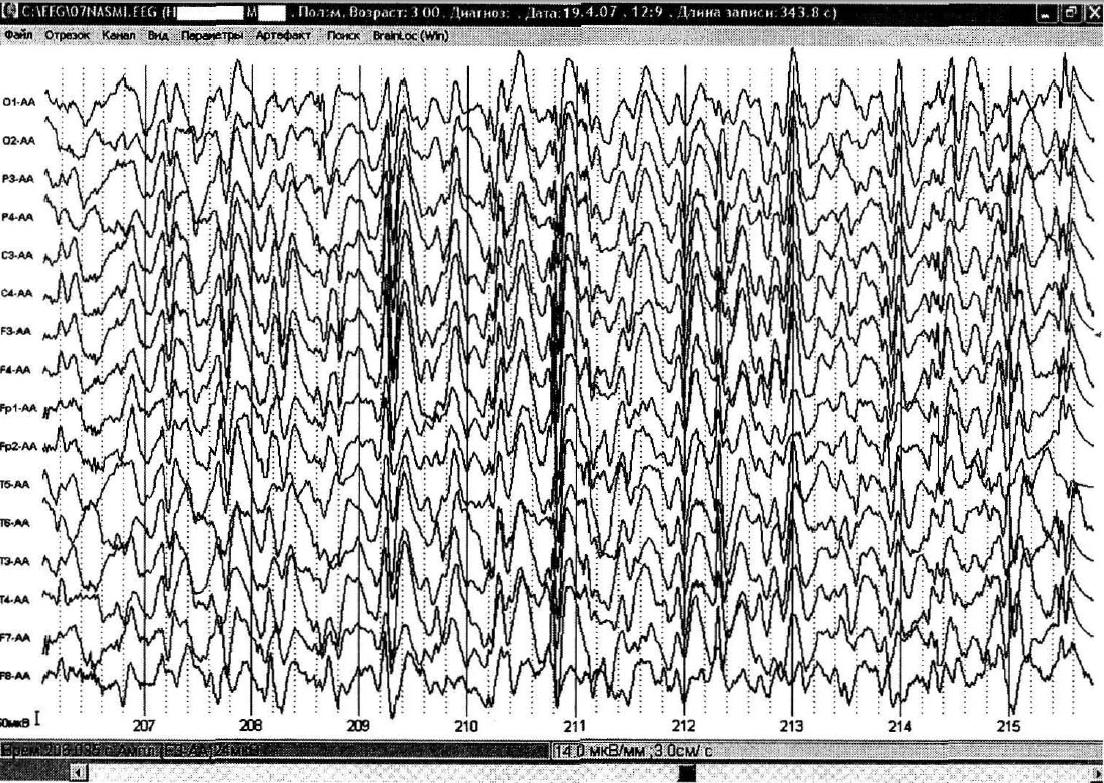 Ээг хороший результат. Нормальная диаграмма ЭЭГ. Спайк волна на ЭЭГ. Гипсаритмия на ЭЭГ. Рисунок нормальных показателей ЭЭГ.