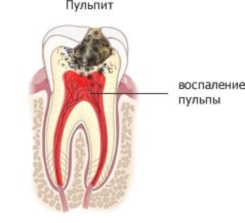 Пульпит что это. Пульпит зуба молочного зуба.