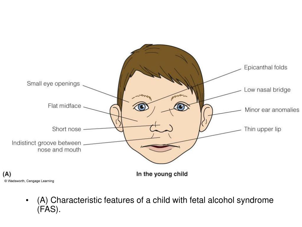 Фетальный алкогольный синдром фото детей