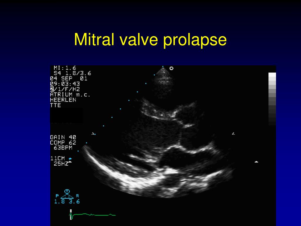 Пролапс митрального клапана презентация