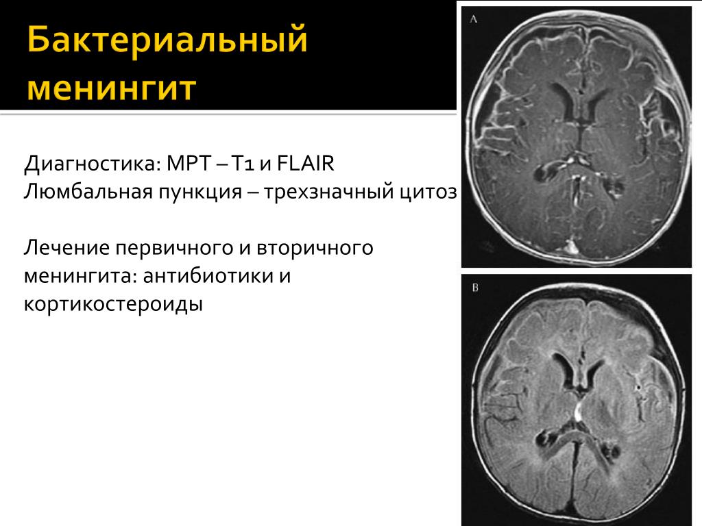 Что такое менингит. Менингококковый менингит мрт. Мозговые оболочки при менингите. Гнойный менингит (бактериальный менингит).