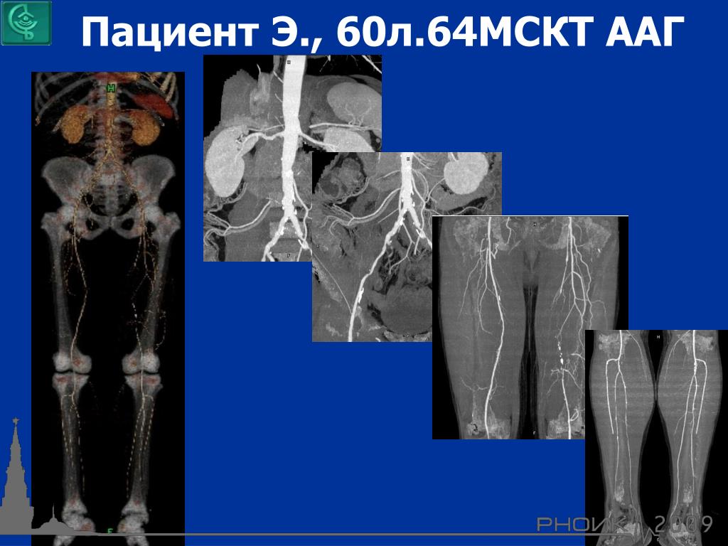 Сделать кт ноги. Кт венография нижних конечностей. Кт ангиография сосудов нижних конечностей. Кт ангиография сосудов нижних конечностей анатомия. МСКТ-ангиография артерий нижних конечностей.