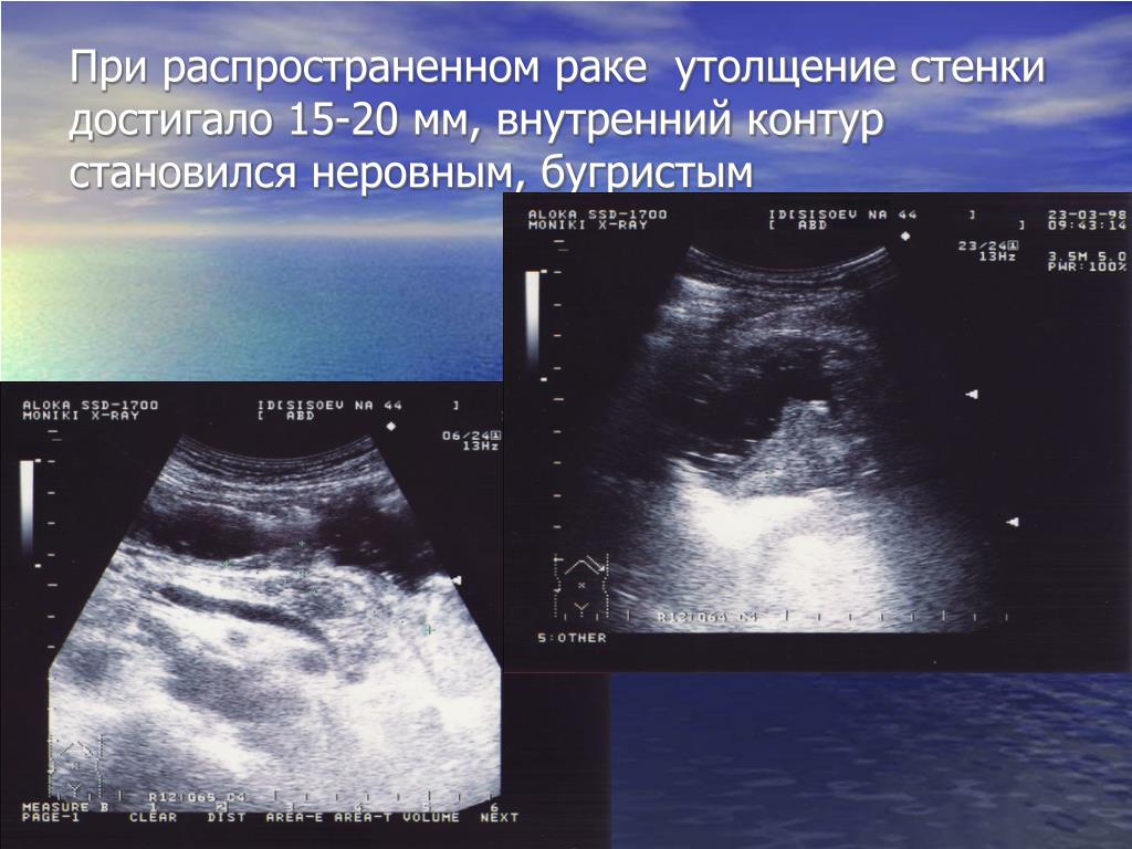 Ультразвуковое изображение серозоцеле представлено