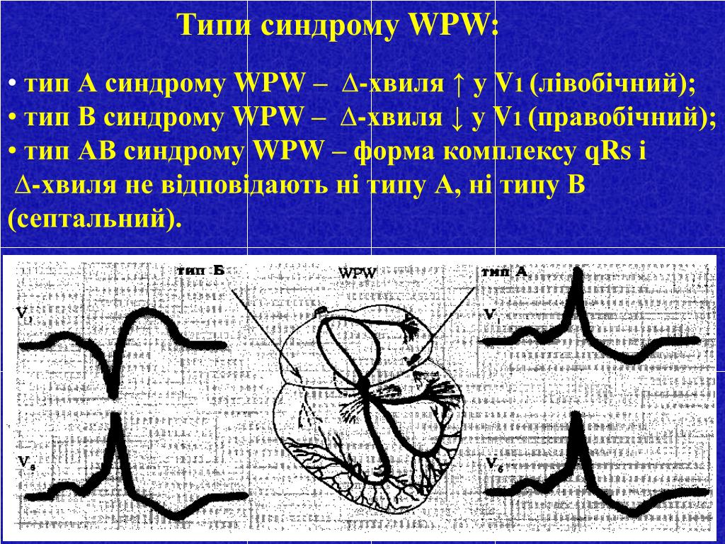 Wpw синдром на экг картинки