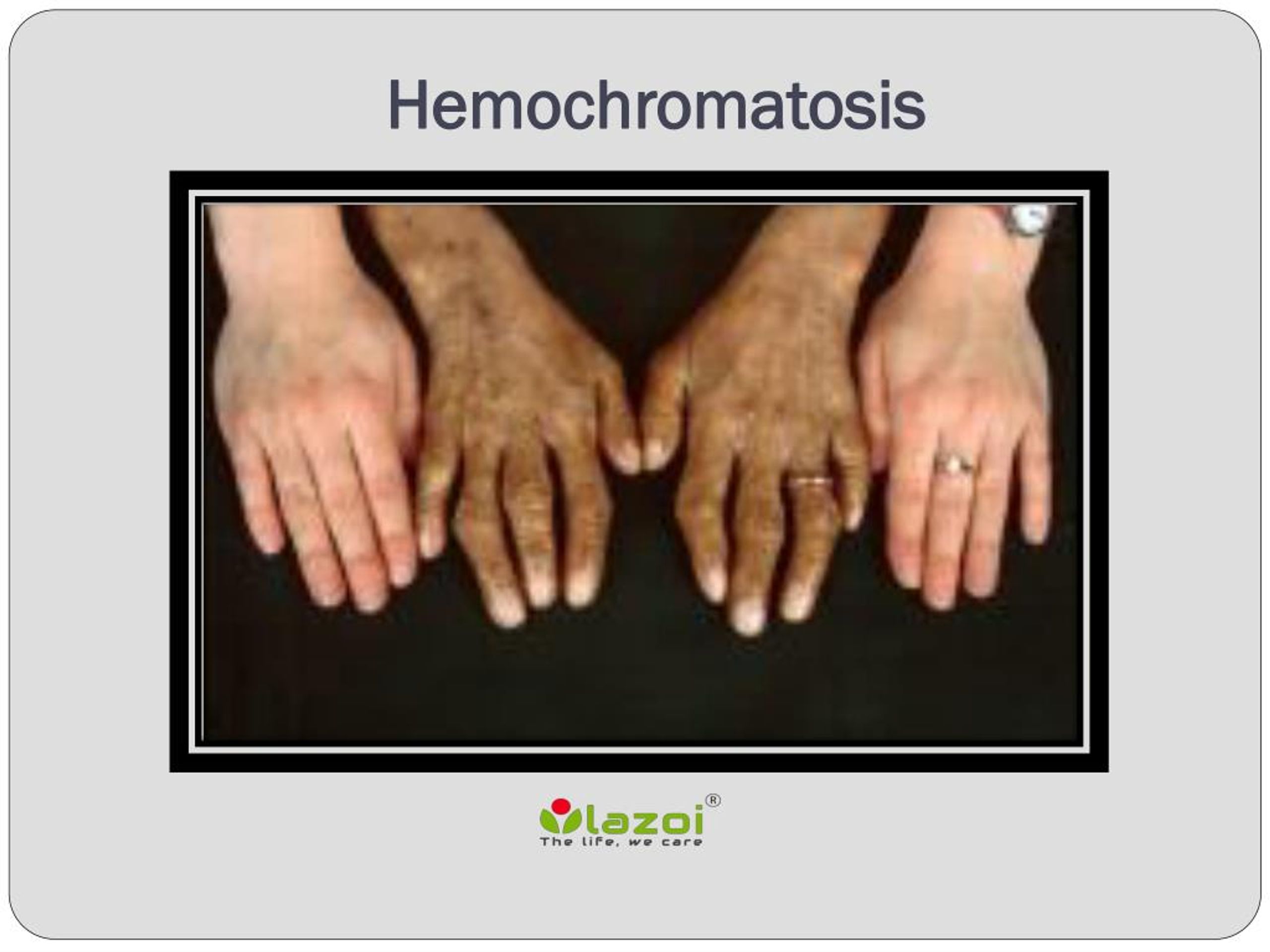 Гемохроматоз симптомы. Г4мвхромотоз.