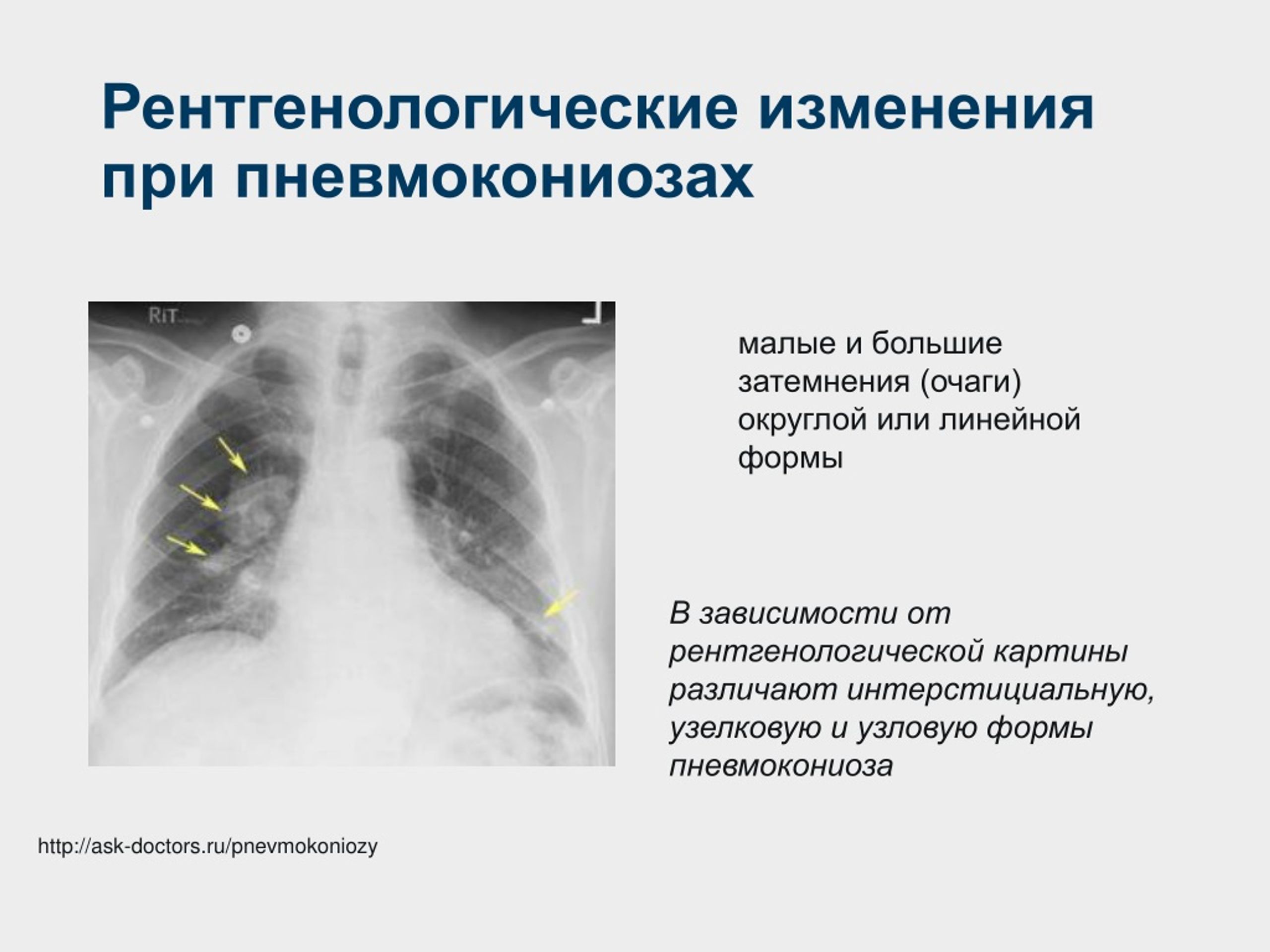 Легочный рисунок с признаками пневмосклероза что это значит