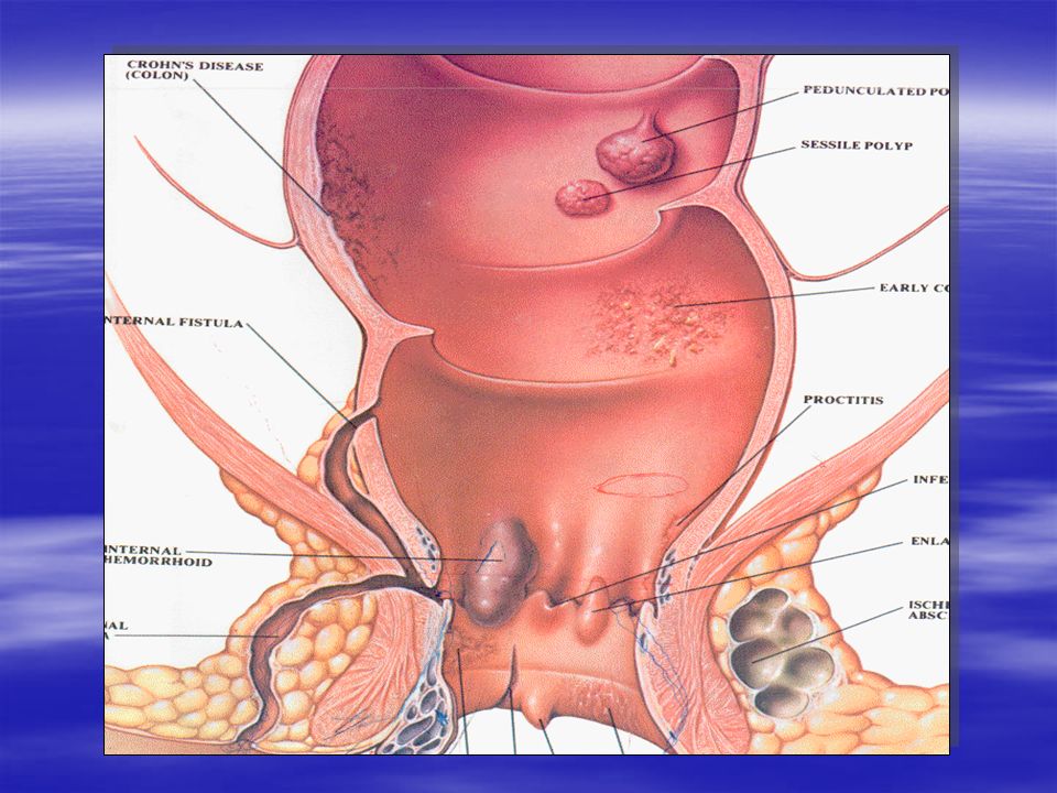 Анальный рак. Сфинктерный проктит симптомы. Хронический Сфинктерный проктит. Наружный полип прямой кишки.