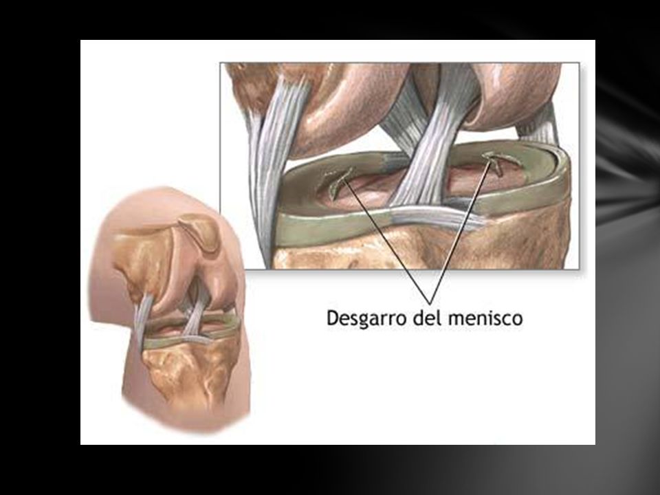 Разрыв медиальной. Повреждение мениска коленного сустава операция. Разрыв мениска коленного операция. Разрыв мениска и крестообразной связки. Порван мениск коленного сустава.