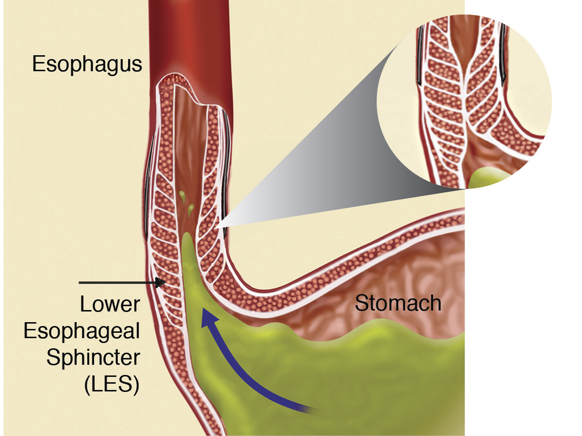 Нижний пищевод. Терминальный катаральный эзофагит. Рефлюкс-эзофагит сфинктер.