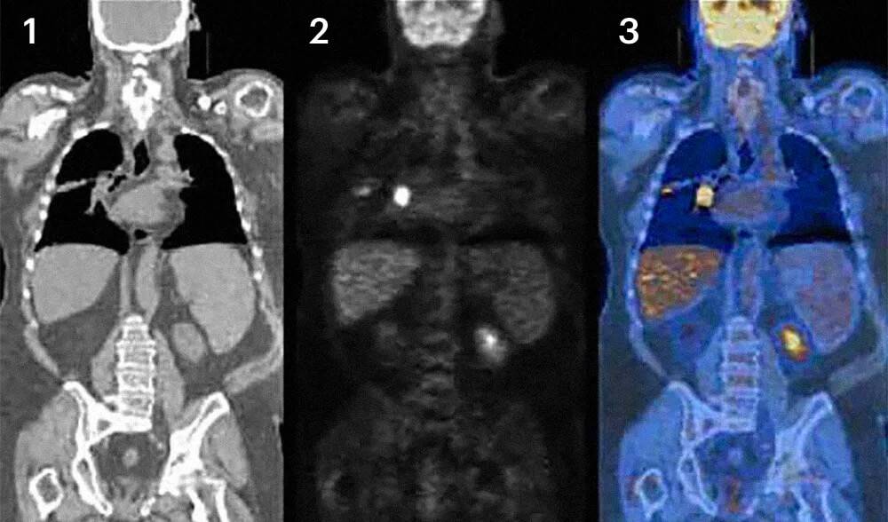 Что такое пэт кт в онкологии. Позитронно-эмиссионная томография метастазы. ПЭТ кт метастазы в легких. ПЭТ томограмма опухоли.