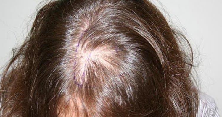 Выпадение волос при гипотиреозе у ребенка