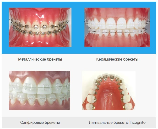 Керамические и металлические брекеты разница фото